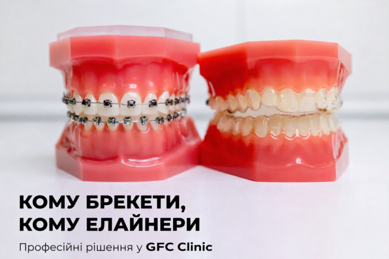 Брекети чи елайнери що краще?